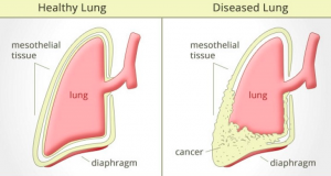 Machine Learning to predict Mesothelioma Cancer